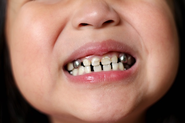 silver crown teeth