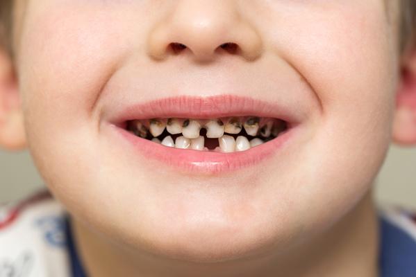 Effective Options For Cavity Treatment For Kids