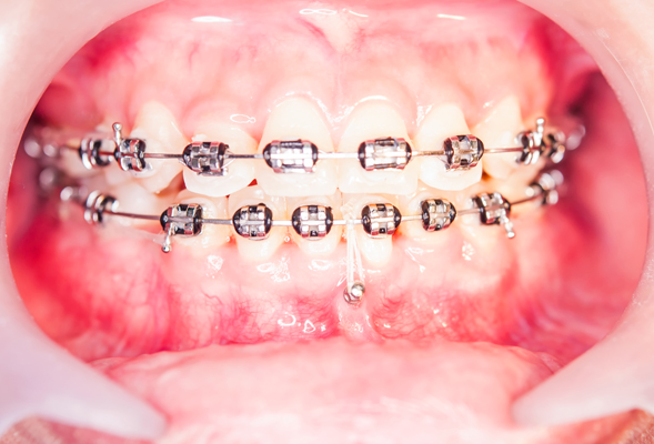 A Parent&#    ;s Guide To Childrens Braces