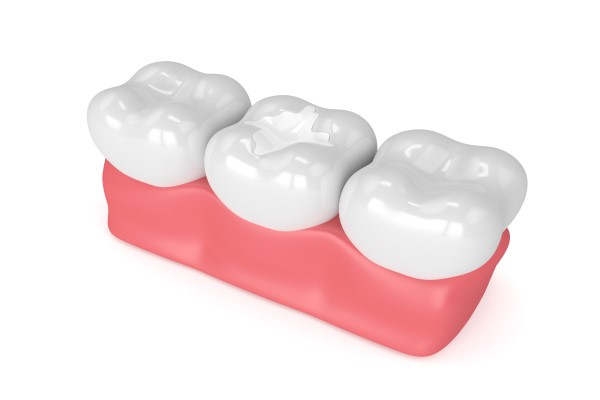 Aftercare Tips For Dental Fillings For Kids