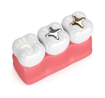 Dental Sealant For Kids Middletown, NY