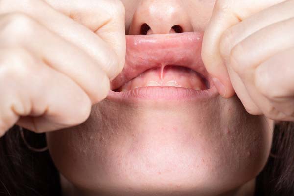 When Is A Laser Frenectomy Needed?