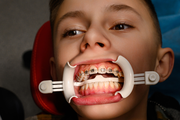 Benefits Of Regular Pediatric Dental Checkups: Keeping Smiles Healthy