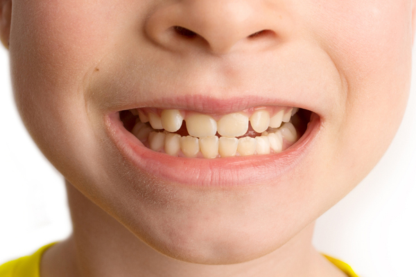 Pediatric Dentistry: Why Does A Child Need Dental Sealants?