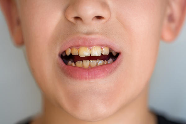 Is Your Child A Candidate For Kids Dental Crowns?